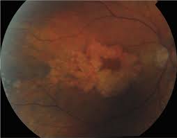 Sorsby Macular Dystrophy