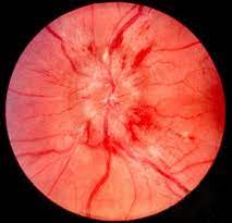 Pseudopapilledema