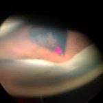 Vitreous Wick Syndrome