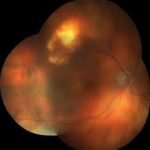 Sclerochoroidal Calcification
