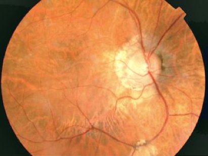Wagner Syndrome