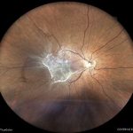Epiretinal Membrane