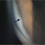 Cyclodialysis Clefts