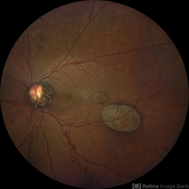 Congenital Hypertrophy of the Retinal Pigment Epithelium (CHRPE)