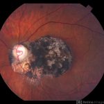 Congenital Hypertrophy of the Retinal Pigment Epithelium