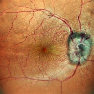 Hypotony Maculopathy