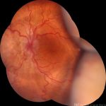 Hypotony Maculopathy