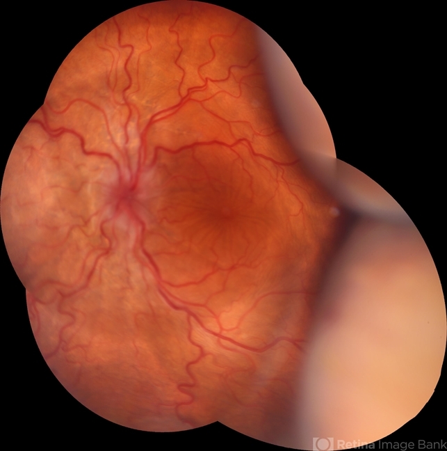 Hypotony Maculopathy