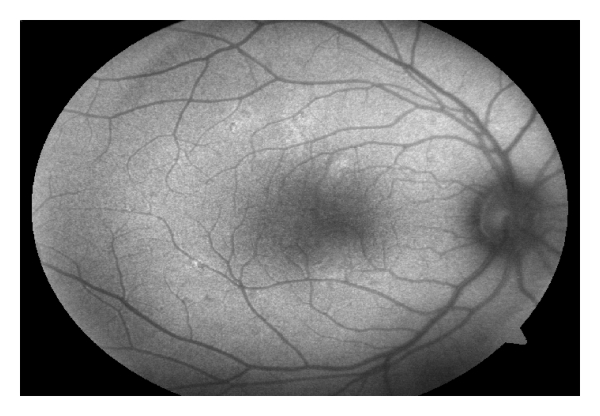Acute Retinal Pigment Epitheliitis (ARPE)