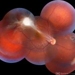 Toxocariasis