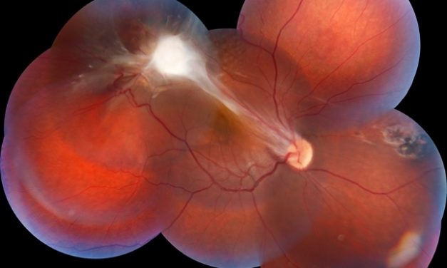 Ocular Toxocariasis: A Rare Encounter in a 10-Year-Old Female