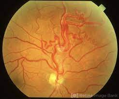 Wyburn-Mason Syndrome: Ocular Manifestations