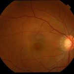 Acute Retinal Pigment Epitheliitis (ARPE)