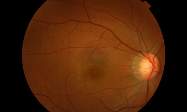 Acute Retinal Pigment Epitheliitis (ARPE): full study
