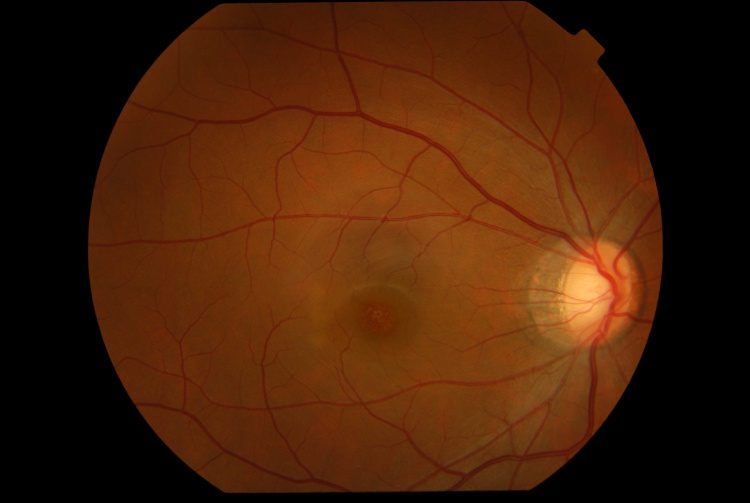 Acute Retinal Pigment Epitheliitis (ARPE): full study