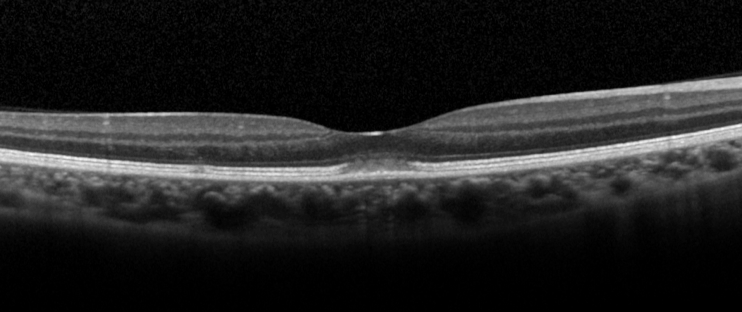 Acute Retinal Pigment Epitheliitis (ARPE)