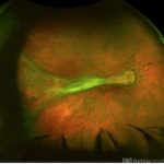 Familial Exudative Vitreoretinopathy (FEVR)