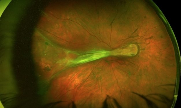 Familial Exudative Vitreoretinopathy (FEVR): what is it?!