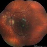 Punctate Inner Choroidopathy