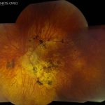 Bardet-Biedl Syndrome