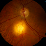 Focal Scleral Nodule (FSN)