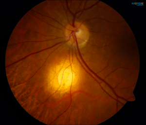 Focal Scleral Nodule (FSN): The Eye’s Enigmatic Visitor