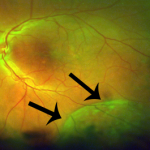 Senile Retinoschisis
