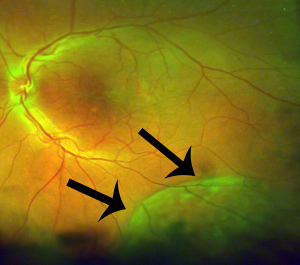 Senile Retinoschisis: Vision Saving Strategies