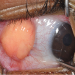 Juvenile Xanthogranuloma (JXG)
