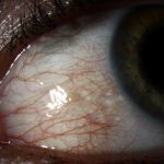 Conjunctival Lymphangiectasia