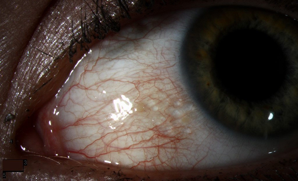 Conjunctival Lymphangiectasia: Best treatment strategies