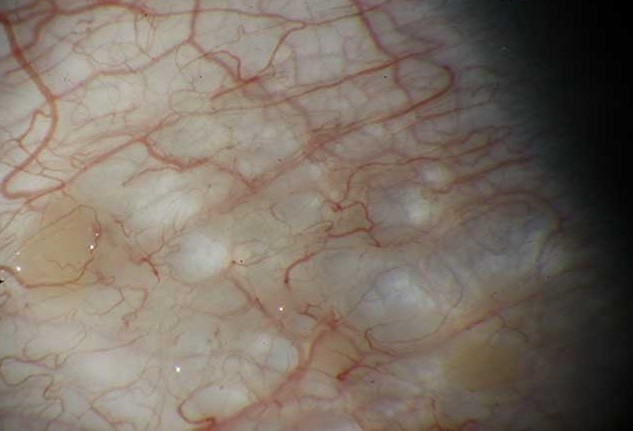 Conjunctival Lymphangiectasia