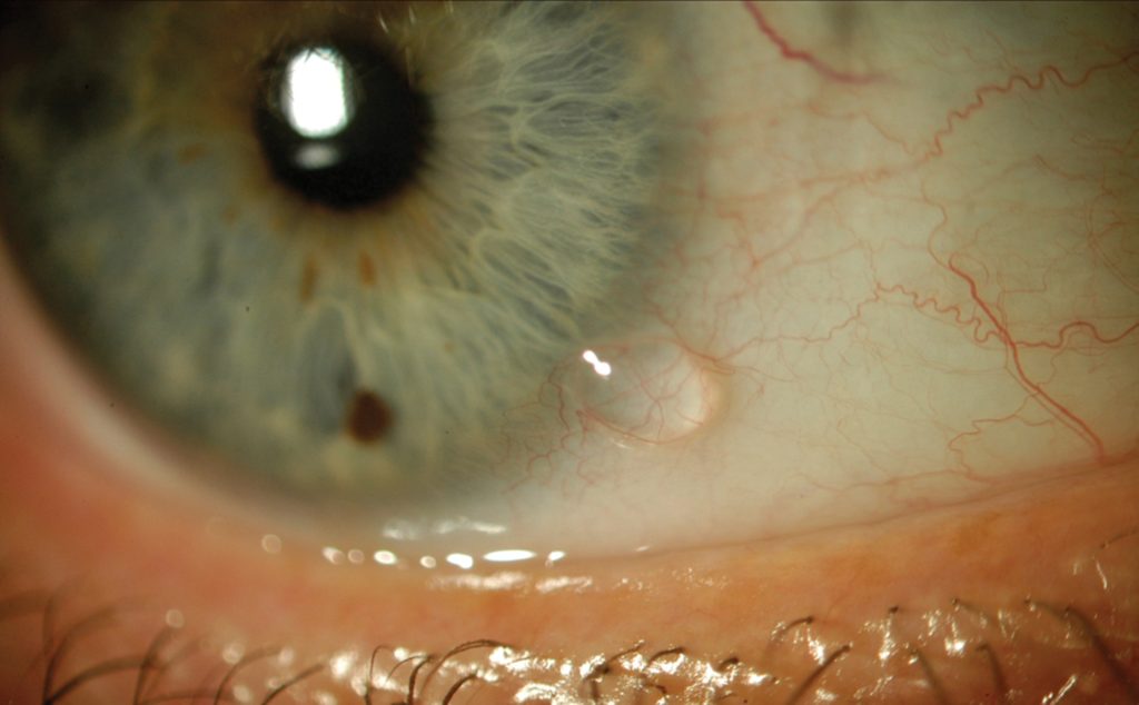 Conjunctival Lymphangiectasia