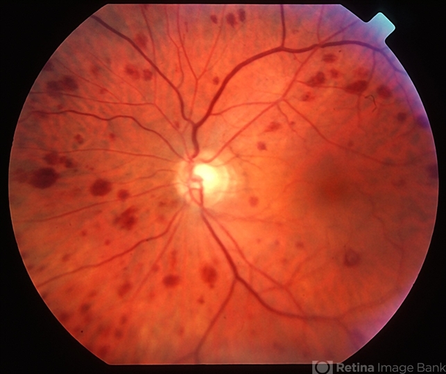 Ocular Ischemic Syndrome