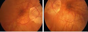 Dome-shaped macula