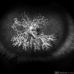 Ocular Ischemic Syndrome
