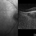 Dome-shaped macula