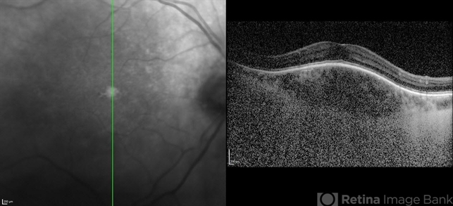 Dome-Shaped Macula (DSM) Unveiled: A Myopic Eye’s Journey