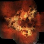 Serpiginous Choroidopathy