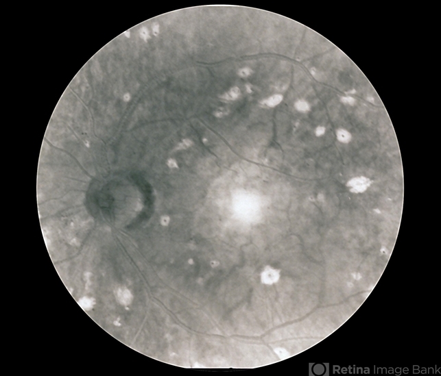 Ocular Ischemic Syndrome