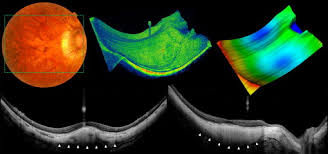 Dome-shaped macula