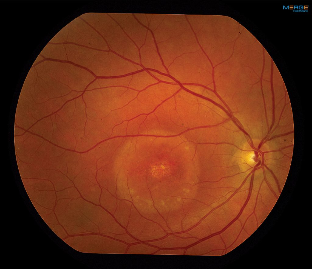 Peripapillary Pachychoroid Syndrome