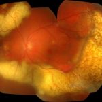 Intraocular Lymphoma