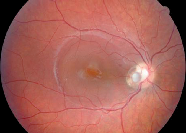 Optic Pits Case Study Entity And Management Ophthalmology Education Optic Pits Case Study Entity And Management Ophthalmology Education