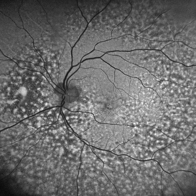 Peripapillary Pachychoroid Syndrome (PPS): ِA full study