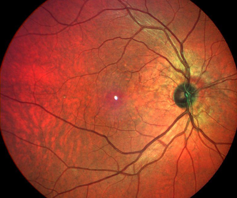 Focal Choroidal Excavation (FCE): What is it?!