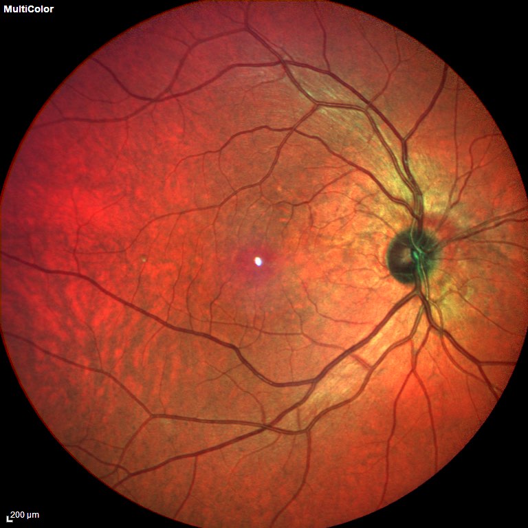 Focal Choroidal Excavation