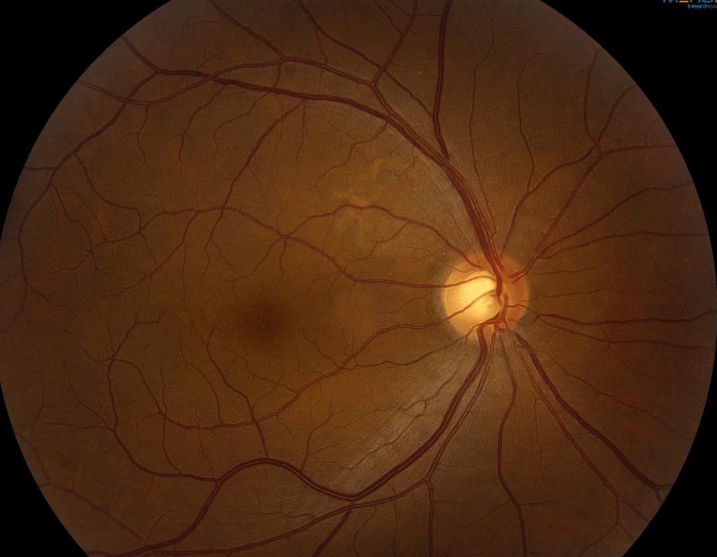 Focal Choroidal Excavation