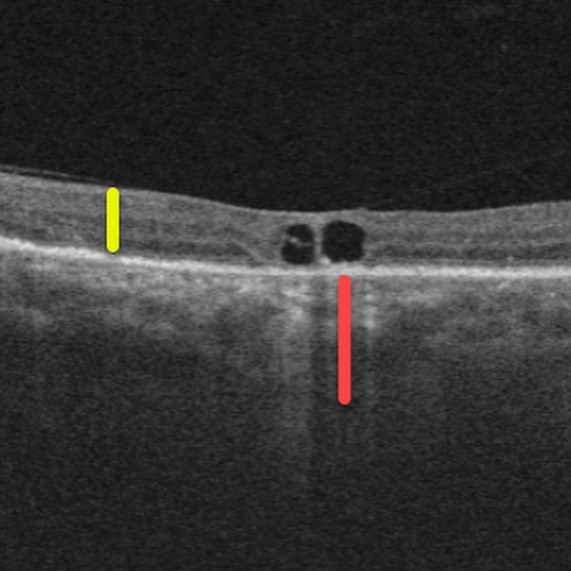 Peripapillary Pachychoroid Syndrome