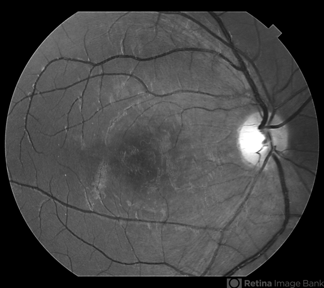Diffuse Unilateral Subacute Neuroretinitis